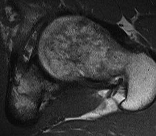 Hip MRI Anterior CAM